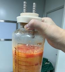 汶上水动力吸脂手术要做多久？